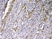 VDBP Antibody Rectal Cancer IHC. Immunohistochemistry analysis of FFPE human rectal cancer tissue stained with VDBP antibody demonstrates granular cytoplasmic HRP-DAB brown staining within gland-forming tumor epithelial cellular populations, consistent with expression of Vitamin D binding protein / VDBP in circulating transport and metabolic homeostasis-associated pathways. The observed staining profile aligns with the secretory biology of this vitamin D-associated serum carrier protein within epithelial-derived tumor tissue. Required HIER: steam tissue sections in pH 6 citrate buffer for 20 min and allow to cool prior to testing.