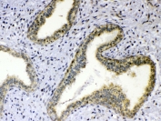 IHC testing of FFPE human breast cancer tissue with TNFSF18 antibody at 1ug/ml. Required HIER: steam section in pH6 citrate buffer for 20 min and allow to cool prior to testing.