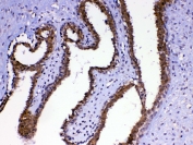 IHC testing of FFPE human breast cancer tissue with MED4 antibody at 1ug/ml. Required HIER: steam section in pH6 citrate buffer for 20 min and allow to cool prior to testing.