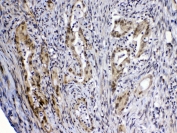 IHC testing of FFPE human rectal cancer tissue with MED4 antibody at 1ug/ml. Required HIER: steam section in pH6 citrate buffer for 20 min and allow to cool prior to testing.
