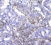 CD44 Antibody Colon Cancer IHC. Immunohistochemistry analysis of CD44 / CD44 antigen expression in FFPE human colon cancer tissue using rabbit polyclonal antibody at 1 ug/ml. Membranous HRP-DAB brown staining is observed in tumor epithelial cells, outlining cell borders and highlighting cell surface localization consistent with CD44 expression. The staining pattern demonstrates heterogeneous intensity across tumor regions and supports its use for evaluating CD44 distribution, tumor cell organization, and microenvironment-associated expression in colorectal carcinoma tissue. Heat induced epitope retrieval was performed by steaming tissue sections in pH 6 citrate buffer for 20 min followed by cooling prior to testing.