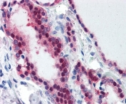 IHC staining of FFPE human thyroid tissue with TIA1 antibody at 3.75ug/ml. Required HIER: steamed antigen retrieval with pH6 citrate buffer; AP-staining.