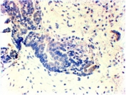 HER2 Antibody TNBC Negative IHC. Immunohistochemistry analysis of FFPE human triple negative breast carcinoma tissue using HER2 Antibody shows absence of HRP-DAB brown membranous staining in tumor epithelial cells, consistent with lack of ErbB2 / HER2 expression in TNBC, while background stromal tissue remains largely unstained; nuclei are counterstained blue. HIER: steamed sections in pH 6 citrate buffer followed by HRP-based detection.