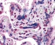 GBX2 Antibody Placenta IHC. Immunohistochemistry analysis of FFPE human placenta tissue stained with GBX2 Antibody / Developmental Patterning Protein Antibody demonstrates prominent nuclear AP-blue staining within trophoblast-associated cellular populations, consistent with the role of Gastrulation brain homeobox 2 / GBX2 in embryonic development and tissue differentiation-associated transcriptional regulation. The observed nuclear localization pattern aligns with the established function of GBX2 as a developmental homeobox transcription factor involved in embryonic patterning pathways. HIER: steamed with pH 6 citrate buffer. AP-based detection chemistry was used for visualization.