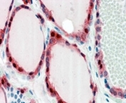 Frizzled 2 Antibody / Wnt Receptor Antibody Human Thyroid IHC. Immunohistochemical staining of FFPE human thyroid gland using Frizzled 2 Antibody / Wnt Receptor Antibody at 2.5 ug/ml. FZD2 expression is observed predominantly along the membranes and within the cytoplasm of thyroid follicular epithelial cells, consistent with its role as a Wnt receptor regulating epithelial polarity, differentiation, and intracellular signaling. Heat-induced epitope retrieval was performed by steaming sections in pH 6 citrate buffer prior to AP-based immunostaining.