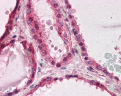 IHC testing of FFPE human thyroid tissue with LIS1 antibody at 3.75ug/ml. Required HIER: steamed antigen retrieval with pH6 citrate buffer; AP-staining.