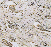 DNMT1 Antibody Breast Cancer Tissue IHC. Immunohistochemistry analysis of FFPE human breast carcinoma tissue using DNMT1 Antibody shows nuclear HRP-DAB brown staining in tumor epithelial cells, consistent with localization of DNMT1 / DNA methyltransferase 1 as a nuclear epigenetic regulator. Staining intensity varies across tumor regions, with positive nuclei distributed within malignant cell populations, while surrounding stromal elements display lower signal. Hematoxylin counterstain provides nuclear contrast and tissue architecture. HIER: boil FFPE tissue sections in pH 8 EDTA for 20 min and allow to cool before testing.