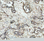 DNMT1 Antibody Pancreatic Cancer Tissue IHC. Immunohistochemistry analysis of FFPE human pancreatic carcinoma tissue using DNMT1 Antibody shows nuclear HRP-DAB brown staining in tumor epithelial cells, consistent with localization of DNMT1 / DNA methyltransferase 1 as a nuclear epigenetic regulator. Positive nuclei are observed within malignant glandular structures, while surrounding stromal regions display lower staining intensity. Hematoxylin counterstain provides nuclear contrast and tissue architecture. HIER: boil FFPE tissue sections in pH 8 EDTA for 20 min and allow to cool before testing.