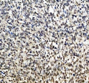 IHC staining of FFPE human melanoma tissue with SOX10 antibody. HIER: boil tissue sections in pH8 EDTA for 20 min and allow to cool before testing.