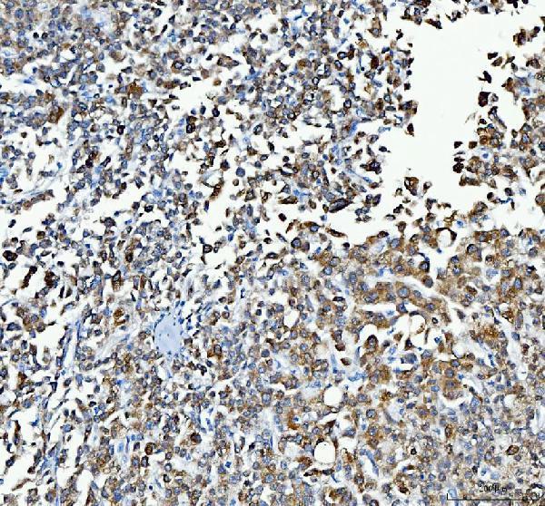 UGT1A1 Antibody / Drug Metabolism Enzyme Antibody Human Liver Cancer IHC. Immunohistochemical staining of FFPE human liver cancer tissue using UGT1A1 Antibody / Drug Metabolism Enzyme Antibody. UGT1A1 expression is detected predominantly within the cytoplasm of tumor cells, consistent with its role as a Phase II metabolic enzyme that catalyzes bilirubin conjugation and glucuronidation of endogenous compounds, xenobiotics, and therapeutic drugs. Heat-induced epitope retrieval was performed in pH 8.0 EDTA buffer prior to staining. Tissue sections were blocked with 10% goat serum and incubated with the primary antibody (2 ug/ml) overnight at 4Â°C, followed by a peroxidase-conjugated goat anti-rabbit IgG secondary antibody. Immunoreactivity was visualized using an HRP Super Vision detection system with DAB as the chromogen.