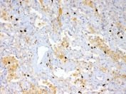 IHC testing of FFPE human lung cancer tissue with Psoriasin antibody at 1ug/ml. Required HIER: steam section in pH6 citrate buffer for 20 min and allow to cool prior to testing.