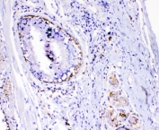 TL1A Antibody Lung Cancer Immunohistochemistry. IHC testing of FFPE human lung cancer with TL1A antibody. HIER: boil tissue sections in pH6, 10mM citrate buffer, for 10-20 min followed by cooling at RT for 20 min.