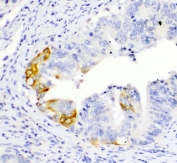 TL1A Antibody Intestine Cancer Immunohistochemistry. IHC testing of FFPE human intestinal cancer with TL1A antibody. HIER: boil tissue sections in pH6, 10mM citrate buffer, for 10-20 min followed by cooling at RT for 20 min.