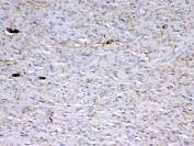 GAD65 Antibody Glioma IHC. Immunohistochemistry testing of FFPE human glioma with polyclonal GAD65 antibody at 1ug/ml. Required HIER: steam section in pH6 citrate buffer for 20 min and allow to cool prior to testing.