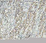 Immunohistochemical staining of FFPE human bladder cancer tissue using GSTM3 antibody. Staining is observed predominantly in tumor epithelial cells, with cytoplasmic localization. Visualization was performed using an HRP-conjugated secondary antibody and DAB substrate, with hematoxylin counterstaining. Heat-induced epitope retrieval was performed using EDTA buffer (pH 8.0).