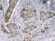 FZD3 Antibody Breast Cancer IHC. Immunohistochemical staining of FFPE human breast cancer tissue using FZD3 Antibody demonstrates moderate to strong membranous and cytoplasmic staining within malignant epithelial cells. FZD3 is a Wnt signaling receptor that regulates cell polarity, developmental signaling, and tissue morphogenesis, and has been implicated in pathways associated with tumor progression and cellular migration. The observed staining pattern is consistent with FZD3 expression in breast carcinoma cells and supports the utility of this antibody for immunohistochemical detection of Frizzled 3 in FFPE tissues. HIER: steam section in pH6 citrate buffer for 20 minutes and allow to cool prior to testing.