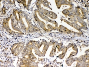 FZD3 Antibody Colon Cancer IHC. Immunohistochemical staining of FFPE human colon cancer tissue using FZD3 Antibody demonstrates moderate membranous and cytoplasmic staining within malignant gland-forming epithelial cells. FZD3 is a Frizzled family Wnt signaling receptor that regulates cell polarity, tissue organization, and developmental signaling pathways frequently dysregulated in colorectal tumorigenesis. The observed staining pattern is consistent with FZD3 expression in colon carcinoma cells and supports the utility of this antibody for immunohistochemical detection of Frizzled 3 in FFPE tissues. HIER: steam section in pH6 citrate buffer for 20 minutes and allow to cool prior to testing.
