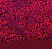 Immunofluorescent staining of FFPE human testis cancer tissue with DYNLT1 antibody (red) and DAPI nuclear stain (blue). HIER: steam section in pH8 EDTA buffer for 20 min.
