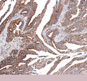 Immunohistochemical staining of FFPE human colon adenocarcinoma tissue with DYNLT1 antibody, HRP-secondary and DAB substrate. HIER: boil tissue sections in pH8 EDTA for 20 min and allow to cool before testing.