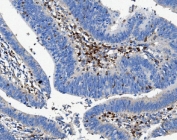 CD16 Antibody Rectal Cancer IHC. Immunohistochemistry analysis of FFPE human rectal cancer tissue stained with CD16 antibody following HIER in pH 8 EDTA buffer. Distinct HRP-DAB brown staining is observed in infiltrating immune cell populations within the tumor stroma and gland-associated regions, consistent with expression of FCGR3 / CD16, an Fc gamma receptor associated with innate immune activation and antibody-dependent cellular cytotoxicity pathways.