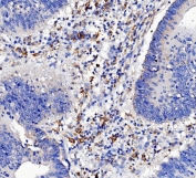 CD16 Antibody Rectal Carcinoma IHC. Immunohistochemistry analysis of FFPE human rectal carcinoma tissue stained with CD16 antibody following HIER in pH 8 EDTA buffer. HRP-DAB brown staining is predominantly observed in stromal and infiltrating immune cell populations surrounding malignant glandular structures, consistent with expression of FCGR3 / CD16, an Fc gamma receptor involved in antibody-dependent cellular cytotoxicity and innate immune signaling within the tumor microenvironment.