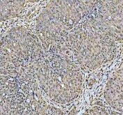 IHC staining of FFPE human ovarian cancer tissue with DCK antibody. HIER: boil tissue sections in pH8 EDTA for 20 min and allow to cool before testing.