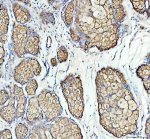 P2RY5 Antibody Human Ovarian Teratoma IHC. Immunohistochemical analysis of FFPE human ovarian teratoma tissue using P2RY5 Antibody. Heat-induced epitope retrieval was performed in pH 8.0 EDTA buffer prior to incubation with the primary antibody at 2 ug/mL overnight at 4Â°C. An HRP-conjugated goat anti-rabbit secondary antibody with DAB chromogen was used for visualization. Distinct membranous and cytoplasmic staining is observed in epithelial cells within the teratoma, consistent with LPAR6/P2RY5 expression. These results demonstrate that P2RY5 Antibody, a Lysophosphatidic Acid Receptor Antibody, specifically detects endogenous receptor expression in FFPE human tissue.