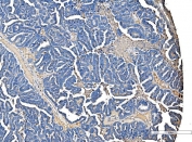IHC staining of FFPE human ovarian serous adenocarcinoma tissue with Serum Amyloid P antibody. HIER: boil tissue sections in pH8 EDTA for 20 min and allow to cool before testing.