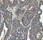 MRE11 Antibody Human Breast Cancer IHC. Immunohistochemical staining of FFPE human breast cancer tissue using MRE11 antibody demonstrated predominantly nuclear staining in tumor cells, consistent with the role of MRE11 as a key component of the MRN complex involved in DNA double-strand break recognition and repair. Heat-induced epitope retrieval was performed in pH 8.0 EDTA buffer prior to staining. Tissue sections were blocked with 10% goat serum and incubated with the primary antibody (2 ug/ml) overnight at 4Â°C, followed by a peroxidase-conjugated goat anti-rabbit IgG secondary antibody. Immunoreactivity was visualized using an HRP Super Vision detection system with DAB as the chromogen. This MRE11 Antibody, also called a DNA Double-Strand Break Repair Protein Antibody, is useful for investigating genome stability, DNA damage response signaling, MRN complex biology, and cancer research.