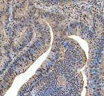 MRE11 Antibody Human Colon Cancer IHC. Immunohistochemical staining of FFPE human colon cancer tissue using MRE11 antibody demonstrated predominantly nuclear staining in malignant epithelial cells, consistent with the localization of MRE11 as a key component of the MRN complex responsible for DNA double-strand break detection and repair. Heat-induced epitope retrieval was performed in pH 8.0 EDTA buffer prior to staining. Tissue sections were blocked with 10% goat serum and incubated with the primary antibody (2 ug/ml) overnight at 4Â°C, followed by a peroxidase-conjugated goat anti-rabbit IgG secondary antibody. Immunoreactivity was visualized using an HRP Super Vision detection system with DAB as the chromogen. This MRE11 Antibody, also called a DNA Double-Strand Break Repair Protein Antibody, is useful for investigating genome stability, DNA damage response signaling, MRN complex biology, and colorectal cancer research.