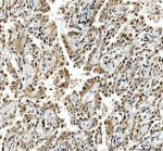 MRE11 Antibody Human Lung Cancer IHC. Immunohistochemical staining of FFPE human lung cancer tissue using MRE11 antibody demonstrated predominantly nuclear staining in malignant cells, consistent with the role of MRE11 in DNA double-strand break recognition, DNA end processing, and genome maintenance as a core component of the MRN complex. Heat-induced epitope retrieval was performed in pH 8.0 EDTA buffer prior to staining. Tissue sections were blocked with 10% goat serum and incubated with the primary antibody (2 ug/ml) overnight at 4Â°C, followed by a peroxidase-conjugated goat anti-rabbit IgG secondary antibody. Immunoreactivity was visualized using an HRP Super Vision detection system with DAB as the chromogen. This MRE11 Antibody, also called a DNA Double-Strand Break Repair Protein Antibody, is useful for investigating DNA damage response signaling, genome stability, MRN complex biology, and lung cancer research.