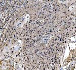 MRE11 Antibody Human Oral Squamous Cell Carcinoma IHC. Immunohistochemical staining of FFPE human oral keratinizing squamous cell carcinoma tissue using MRE11 antibody demonstrated predominantly nuclear staining in malignant epithelial cells, consistent with the localization of MRE11 as a key DNA repair nuclease within the MRN complex. Heat-induced epitope retrieval was performed in pH 8.0 EDTA buffer prior to staining. Tissue sections were blocked with 10% goat serum and incubated with the primary antibody (2 ug/ml) overnight at 4Â°C, followed by a peroxidase-conjugated goat anti-rabbit IgG secondary antibody. Immunoreactivity was visualized using an HRP Super Vision detection system with DAB as the chromogen. This MRE11 Antibody, also called a DNA Double-Strand Break Repair Protein Antibody, is useful for investigating DNA damage response signaling, genome stability, MRN complex biology, and head and neck cancer research.