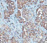 MVP Antibody Human Thyroid Cancer IHC. Immunohistochemical staining of FFPE human thyroid cancer tissue using MVP Antibody / Major Vault Protein Antibody at 2 ug/ml. Heat-induced epitope retrieval was performed using pH8 EDTA buffer, followed by HRP-conjugated secondary antibody detection and DAB chromogen. Strong cytoplasmic staining is observed throughout the tumor cells, consistent with the expected localization of Major Vault Protein. This MVP Antibody, also called Major Vault Protein Antibody, is suitable for studies of vault ribonucleoprotein complexes, intracellular transport, multidrug resistance, and Major Vault Protein expression.