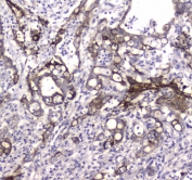 IHC testing of FFPE human colon cancer tissue with LC3A antibody at 1ug/ml. Required HIER: steam section in pH6 citrate buffer for 20 min and allow to cool prior to staining.