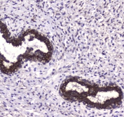 IHC testing of FFPE human breast cancer tissue with LC3A antibody at 1ug/ml. Required HIER: steam section in pH6 citrate buffer for 20 min and allow to cool prior to staining.