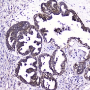 IHC testing of FFPE human ovarian cancer with ATF4 antibody at 2ug/ml. HIER: boil tissue sections in pH6, 10mM citrate buffer, for 10-20 min followed by cooling at RT for 20 min.