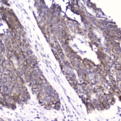 FABP3 Antibody Esophageal Squamous Cell Carcinoma IHC. Immunohistochemistry testing of FFPE human esophageal squamous cell carcinoma with FABP3 antibody at 2ug/ml. HIER: boil tissue sections in pH6, 10mM citrate buffer, for 10-20 min followed by cooling at RT for 20 min.