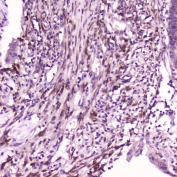 IHC testing of FFPE human intestinal cancer with IL36A antibody at 2ug/ml. HIER: boil tissue sections in pH6, 10mM citrate buffer, for 10-20 min followed by cooling at RT for 20 min.