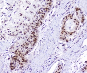 AHR Antibody Esophageal Squamous Carcinoma IHC. Immunohistochemical staining of FFPE human esophageal squamous carcinoma demonstrates AHR expression using an AHR antibody at 1 ug/ml. AHR, also known as Aryl Hydrocarbon Receptor and an Environmental Sensor Protein, is a ligand activated transcription factor that regulates xenobiotic metabolism, inflammatory signaling, and cellular responses to endogenous metabolites. Prominent nuclear staining with accompanying cytoplasmic reactivity is observed in malignant squamous epithelial cells, consistent with activated AHR signaling and its emerging role in tumor progression and epithelial differentiation. Heat induced epitope retrieval was performed by boiling tissue sections in pH 6 10 mM citrate buffer for 10-20 minutes followed by cooling at room temperature for 20 minutes. These results support the utility of AHR Antibody for studies of carcinogenesis, transcriptional regulation, and environmental response pathways.