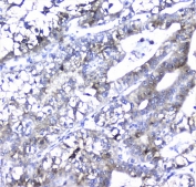 Alpha 1 Microglobulin Antibody Liver Carcinoma IHC. Immunohistochemistry analysis of FFPE human liver carcinoma tissue stained with Alpha 1 Microglobulin Antibody demonstrates diffuse cytoplasmic HRP-DAB brown staining in tumor epithelial cells with heterogeneous intensity across neoplastic glandular structures, consistent with Alpha-1-microglobulin / AMBP-associated secretory protein expression. This Protein HC antibody highlights extracellular glycoprotein-associated signaling and oxidative stress regulatory pathways in liver-derived tumor tissue. HIER: boil tissue sections in pH6, 10mM citrate buffer, for 10-20 min followed by cooling at RT for 20 min.