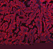 Immunofluorescent staining of FFPE human ovarian cancer tissue with EML4 antibody (red) and DAPI nuclear stain (blue). HIER: steam section in pH8 EDTA buffer for 20 min.