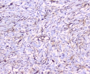 CD32 Antibody Breast Cancer IHC. Immunohistochemistry staining of FFPE human breast cancer with CD32 antibody at 1ug/ml. HIER: boil tissue sections in pH6, 10mM citrate buffer, for 10-20 min followed by cooling at RT for 20 min.