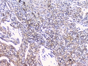 CD32 Antibody Lung Cancer IHC. Immunohistochemistry staining of FFPE human lung cancer with CD32 antibody at 1ug/ml. HIER: boil tissue sections in pH6, 10mM citrate buffer, for 10-20 min followed by cooling at RT for 20 min.