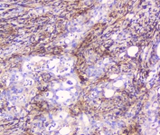 CD32 Antibody Rectal Cancer IHC. Immunohistochemistry staining of FFPE human rectal cancer with CD32 antibody at 1ug/ml. HIER: boil tissue sections in pH6, 10mM citrate buffer, for 10-20 min followed by cooling at RT for 20 min.