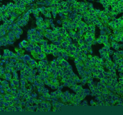 Immunofluorescent staining of FFPE human ovarian cancer tissue with LMAN1 antibody (green) and DAPI nuclear stain (blue). HIER: steam section in pH8 EDTA buffer for 20 min.
