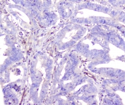 IHC staining of FFPE human colon cancer with ADA antibody at 1ug/ml. HIER: boil tissue sections in pH6, 10mM citrate buffer, for 10-20 min followed by cooling at RT for 20 min.