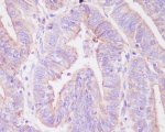 Phospho-FOXO3A (S253) Antibody Human Uterine Cancer IHC. Phospho-FOXO3A (S253) Antibody was used for immunohistochemical staining of FFPE human uterine cancer tissue. Following antigen retrieval, the tissue was incubated with the phospho-specific primary antibody, followed by an HRP-conjugated secondary antibody and chromogenic detection. Predominantly cytoplasmic staining is observed in the malignant epithelial cells, consistent with phosphorylation of FOXO3A at serine 253, an event that promotes nuclear export and transcriptional inactivation through AKT signaling. This Phospho-FOXO3A (S253) Antibody / Phosphorylated FOXO3A Antibody is well suited for investigating PI3K/AKT pathway activation, FOXO3A phosphorylation, growth factor signaling, and phosphorylation-dependent regulation of tumor biology.