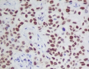 Phospho-JAK2 Antibody Human Tissue IHC. Immunohistochemistry analysis of FFPE human tissue stained with phospho-JAK2 antibody detecting JAK2 phosphorylated at Tyr1007 and Tyr1008, clone IFE-10. Cells show nuclear and cytoplasmic HRP-DAB brown staining, consistent with activation of JAK-STAT signaling pathways, with nuclear signal reflecting downstream transcriptional activity. Nuclei are counterstained blue. HIER: boil tissue sections in pH6, 10 mM citrate buffer for 10-20 minutes followed by cooling.