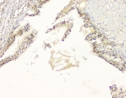 IHC staining of FFPE human renal cancer with APP antibody at 1ug/ml. HIER: boil tissue sections in pH6, 10mM citrate buffer, for 10-20 min and allow to cool before testing.