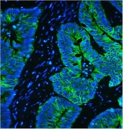 Keratin 8 Antibody Intestinal Cancer IF. Immunofluorescent staining of FFPE human intestinal cancer tissue using Keratin 8 Antibody demonstrates strong green cytoplasmic and membranous staining within malignant epithelial cells. The staining pattern is consistent with expression of Cytokeratin 8 (CK8/KRT8), a type II intermediate filament protein widely expressed in simple epithelial tissues and epithelial-derived carcinomas. CK8 immunoreactivity highlights tumor-associated epithelial architecture and cellular organization, while DAPI (blue) counterstains cell nuclei. HIER: steam tissue sections in pH 8 EDTA buffer for 20 minutes prior to staining.